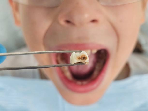 Best Emergency Dental Filling Replacement  in Pineville, KY